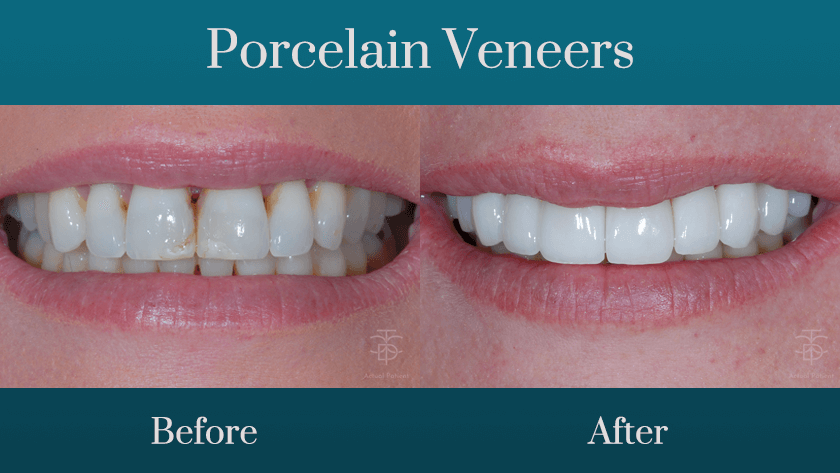 porcelain veneers